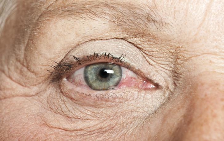 ¿Cómo detectar y tratar el ojo seco?