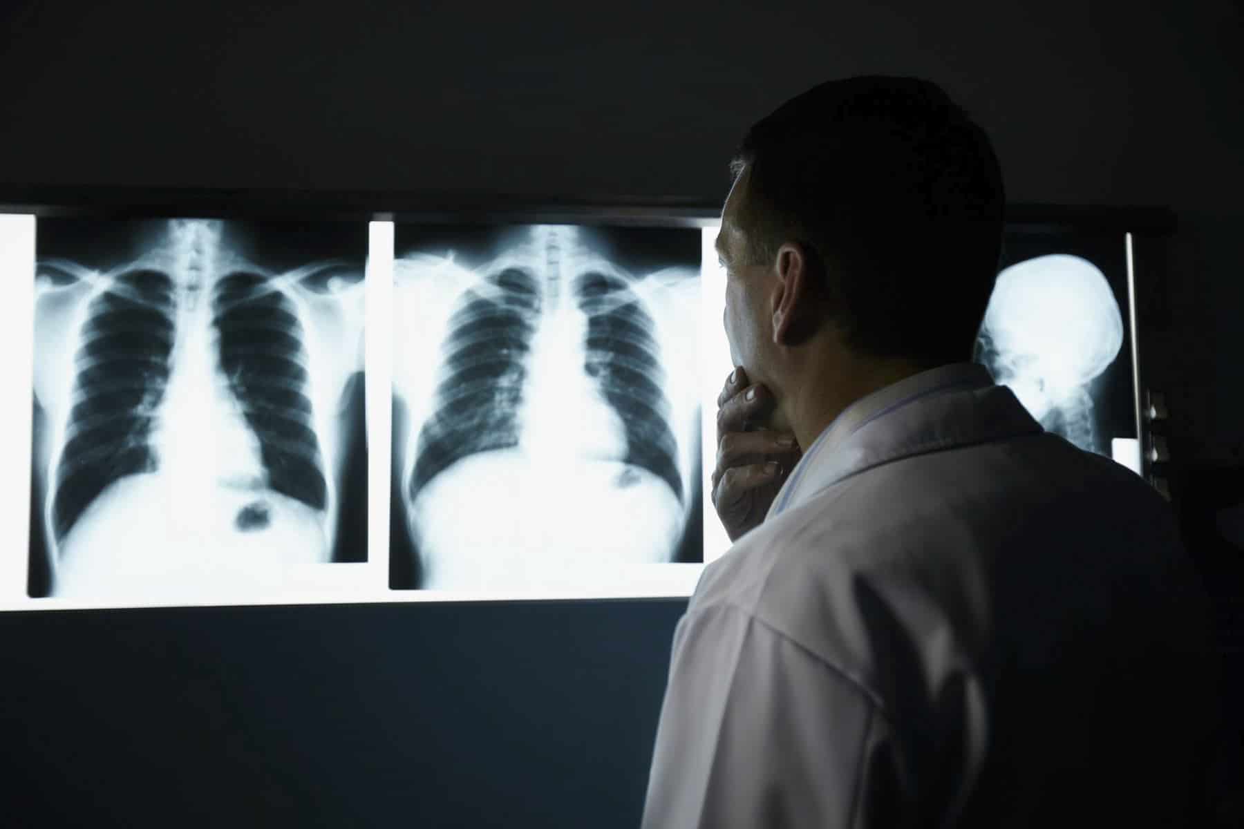 Pleno del Congreso aprueba dictamen para reforzar la atención del cáncer de pulmón