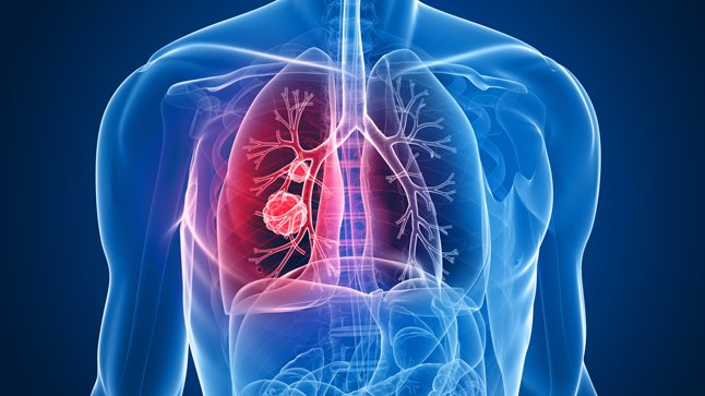 Gusanos podrían detectar cáncer de pulmón mediante el olor