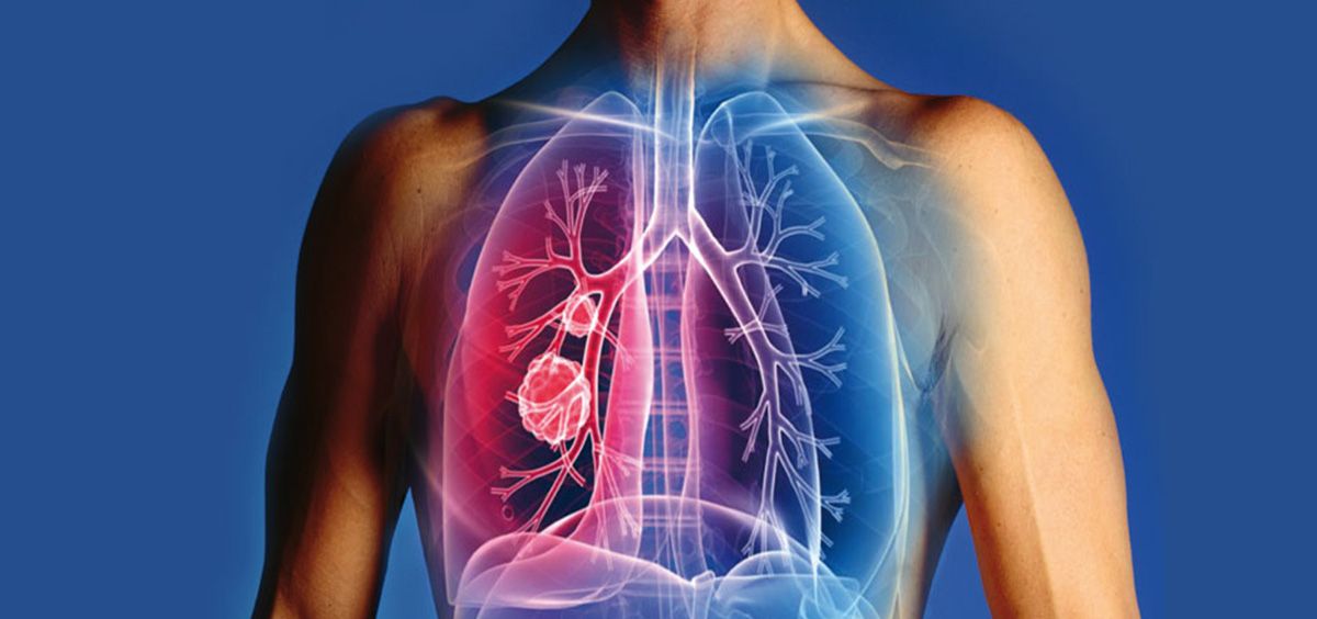 Científicos descubren nuevo tipo de célula en los pulmones