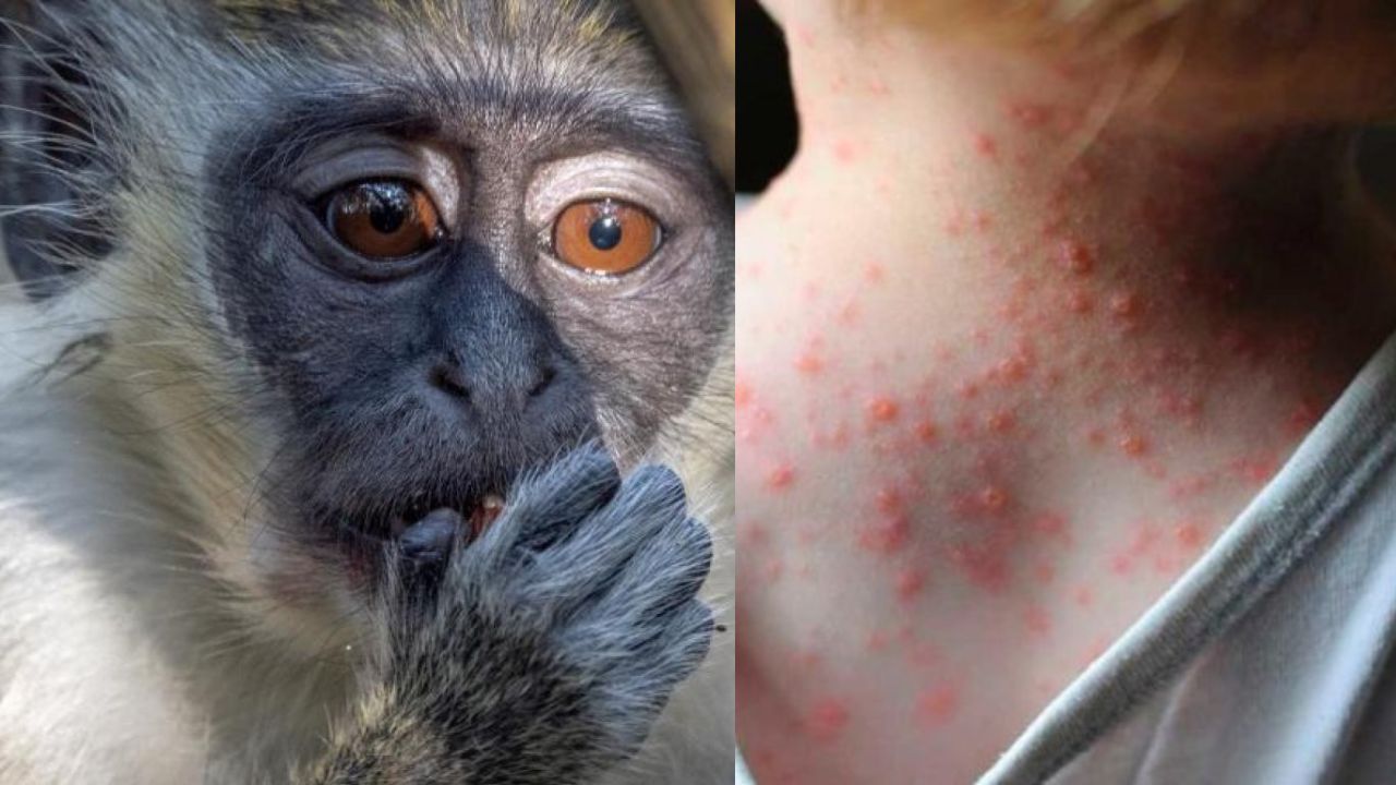 Viruela del mono puede ser declarado en alerta máxima mundial por la OMS