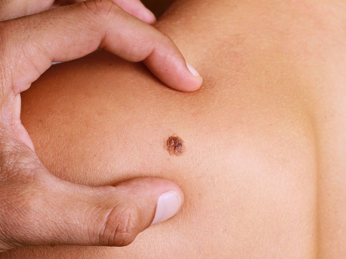 En Perú, al año, cerca de 10 mil personas son detectadas con cáncer de piel