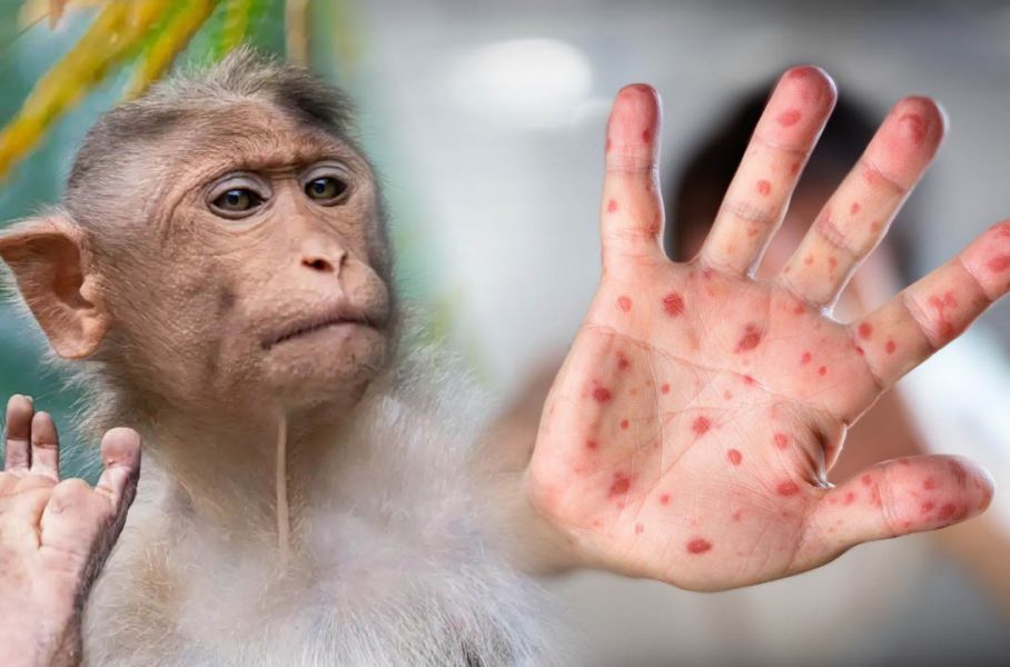 ¡Alerta! Minsa detecta el primer caso de viruela del mono en Piura