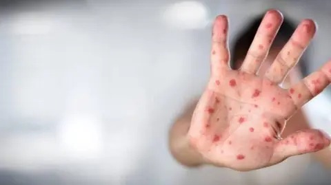 Alemania: Detectan nuevo caso de variante mpox