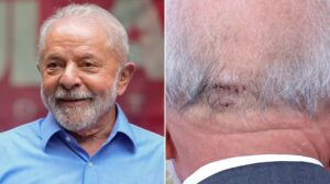 Lula da Silva fue operado por una hemorragia