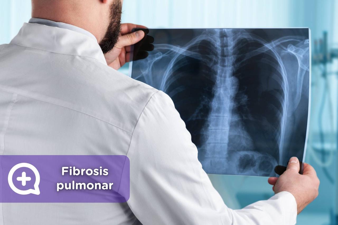 Fibrosis pulmonar: el enemigo silencioso que afecta la respiración