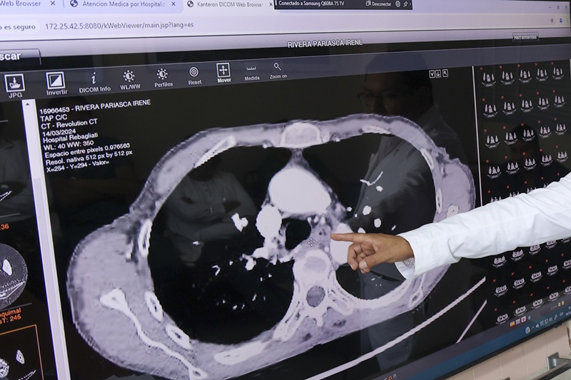 Cirugía de alta complejidad en el esófago salva la vida de dos pacientes en el Hospital Rebagliati