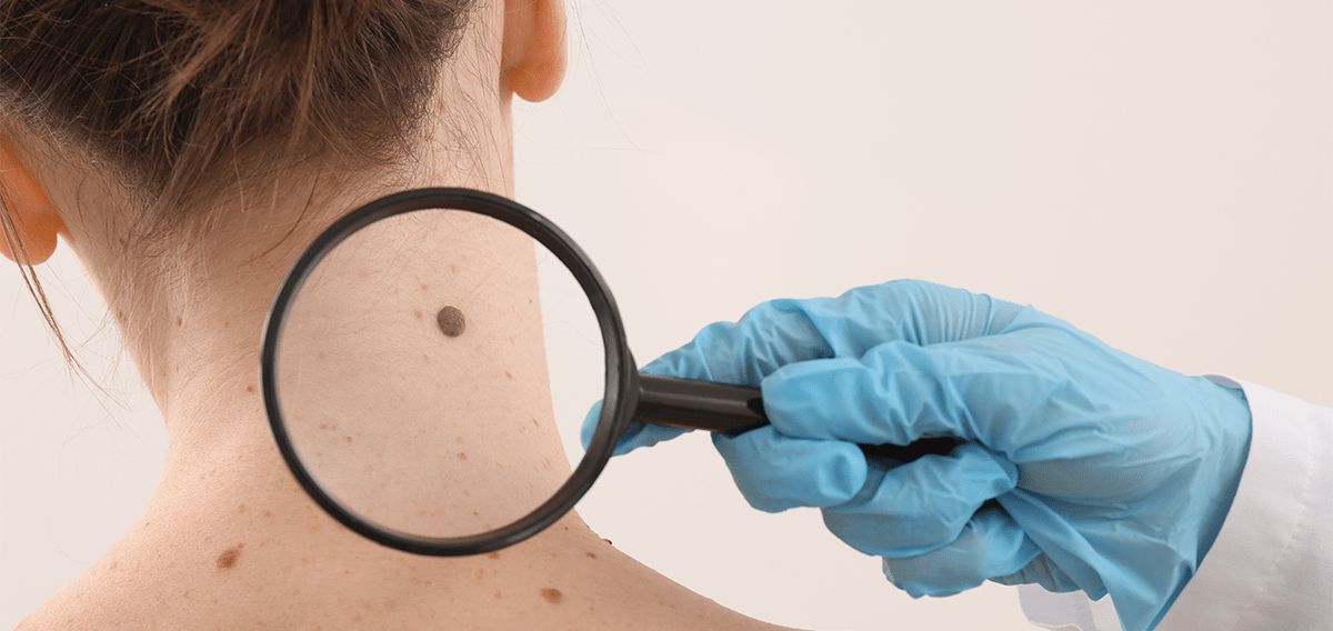 Cáncer de piel: el más prevenible