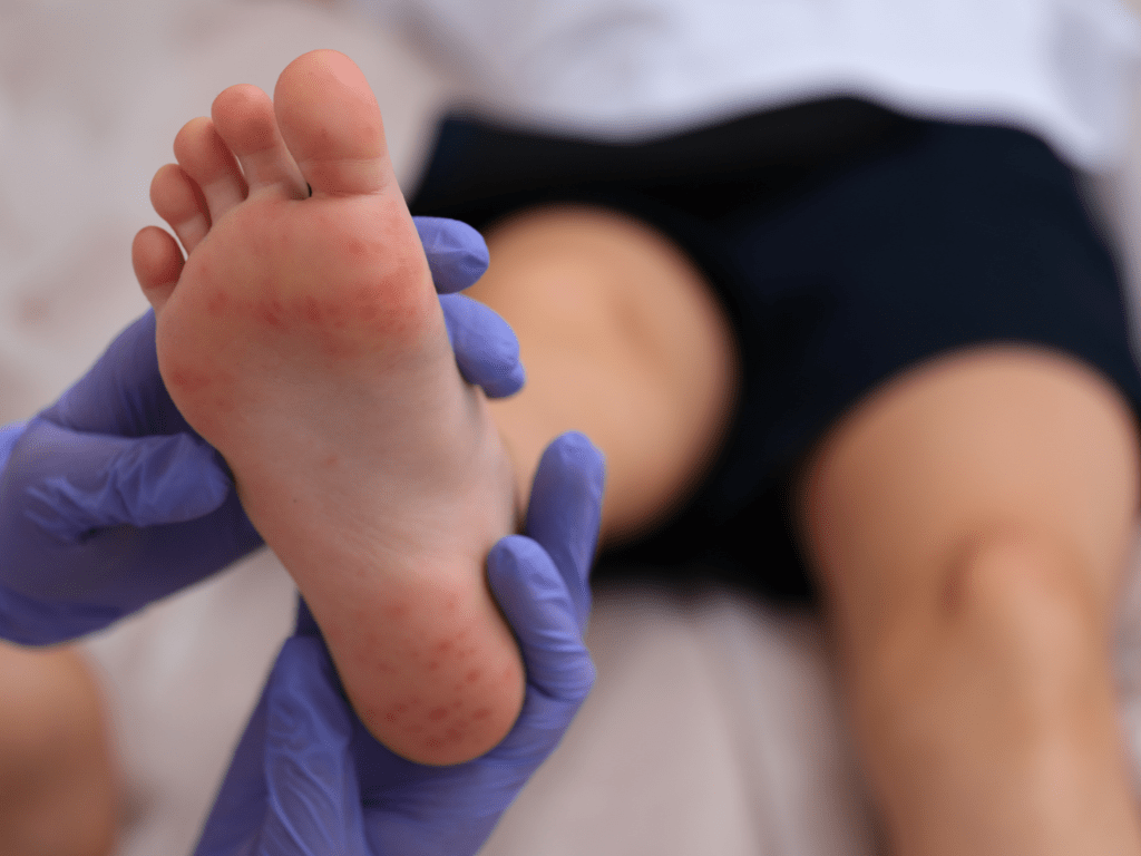 Alerta sanitaria en Lima: detectan virus Coxsackie en colegio y suspenden clases