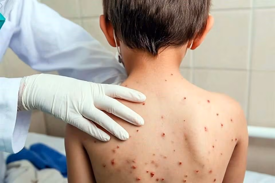 Minsa alerta por aumento de casos de sarampión y refuerza vigilancia sanitaria en todo el Perú